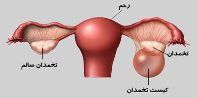 کیست تخمدان،علائم کیست تخمدان علایم کیست تخمدان,درمان کیست تخمدان