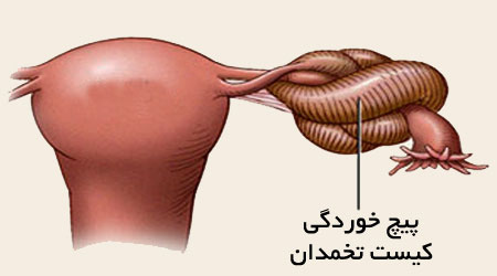 علت پیچ خوردگی تخمدان،علل پیچ خوردگی تخمدان علائم پیچ خوردگی تخمدان,علایم پیچ خوردگی تخمدان