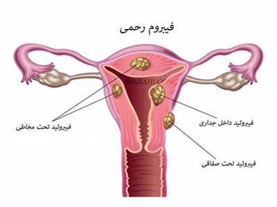 فیبروم،فیبروم رحم درمان گیاهی فیبروم رحمی,فیبروم رحم چیست