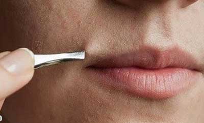 از بین بردن موهای زائد،موهای زائد بدن موهای زائد