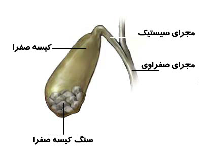 عفونت درون کیسهصفرا، نشانههای التهاب کیسه صفرا کله سیستیت, عوارض کله سیستیت