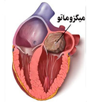 علایم نارسایی میترال، تشخیص نارسایی دریچه ی میترال افتادگی دریچه میترال قلب, تنگی دریچه میترال قلب