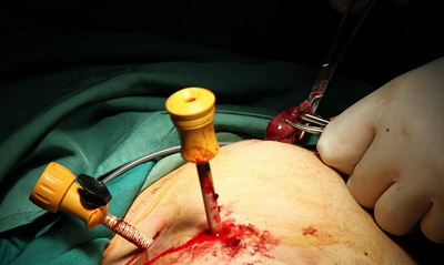 عفونت درون کیسهصفرا، نشانههای التهاب کیسه صفرا کله سیستیت, عوارض کله سیستیت