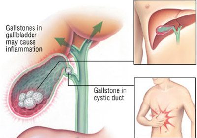 عفونت درون کیسهصفرا، نشانههای التهاب کیسه صفرا کله سیستیت, عوارض کله سیستیت