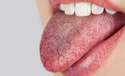 دلیل خشکی دهان در شب، علل تشنگی و خشکی دهان دلایل خشکی دهان, درمان خشکی دهان