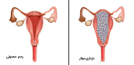 نشانه های بارداری پوچ بارداری پوچ,نشانه های بارداری پوچ,درمان بارداری پوچ