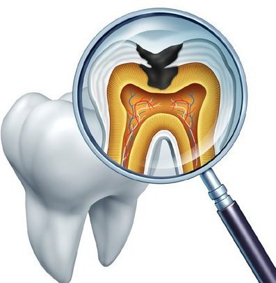 حقایقی درباره پوسیدگی دندان , دندان