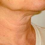 چطور از افتادگی پوست گردن جلوگیری کنیم؟, How to avoid sagging neck skin?, جلوگیری از شل شدن و افتادگی پوست گردن, چطور از افتادگی پوست گردن جلوگیری کنیم؟, شل شدن و افتادگی پوست گردن