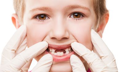 مشکل های رایج رویش دندان های دائمی در کودکان, فرزندان