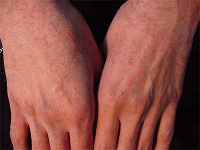 حساسیت پوستی در اثر تماس،نحوه درمان حساسیت پوستی انواع حساسیت پوستی