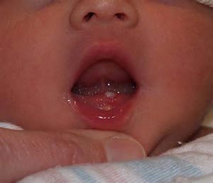 نوزادانی که موقع تولد دندان دارند !, فرزندان