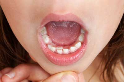 دندانهای دائمی کودکان دندانهای دائمی کودکان