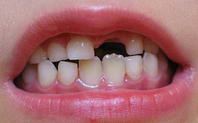 علت بی نظم درآمدن دندان دائمی, فرزندان