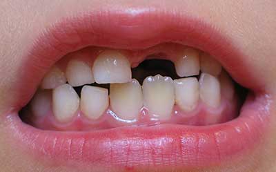دندانهای دائمی کودکان دندانهای دائمی کودکان