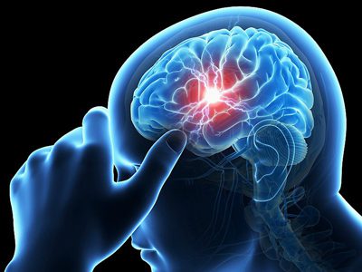 علایم سکته مغزی،علائم سکته مغزی علایم سکته مغزی, علائم سکته مغزی