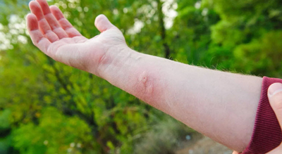 نیش حشرات طب سنتی، تصویر جای نیش حشرات حساسیت به نیش حشرات, درمان جای نیش حشرات