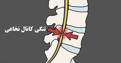 تنگی کانال نخاعی، بی اختیاری ادرار تنگی کانال نخاعی