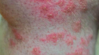 نیش حشرات طب سنتی، تصویر جای نیش حشرات حساسیت به نیش حشرات, درمان جای نیش حشرات