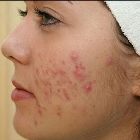 جای جوش را چگونه از بین ببریم؟ جای جوش را چگونه از بین ببریم؟