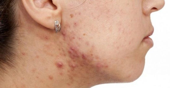 جای جوش را چگونه از بین ببریم؟ جای جوش را چگونه از بین ببریم؟