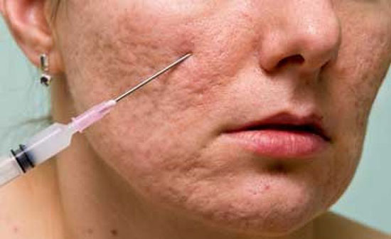 جای جوش را چگونه از بین ببریم؟ جای جوش را چگونه از بین ببریم؟