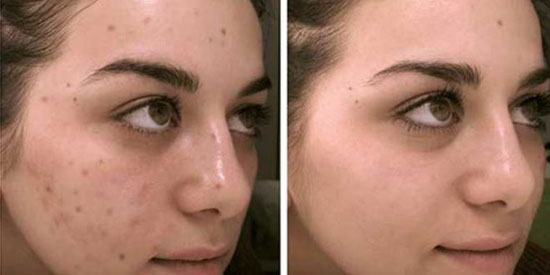 جای جوش را چگونه از بین ببریم؟ جای جوش را چگونه از بین ببریم؟